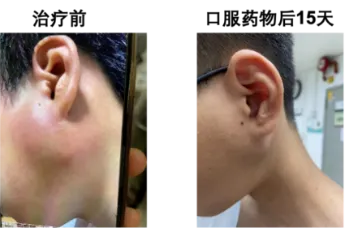 泛癌种精准疗法：新一代NTRK抑制剂佐来曲替尼的临床数据与应