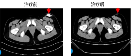 泛癌种精准疗法：新一代NTRK抑制剂佐来曲替尼的临床数据与应