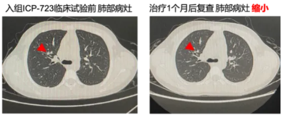 泛癌种精准疗法：新一代NTRK抑制剂佐来曲替尼的临床数据与应