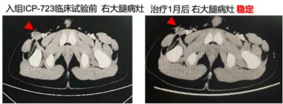 泛癌种精准疗法：新一代NTRK抑制剂佐来曲替尼的临床数据与应