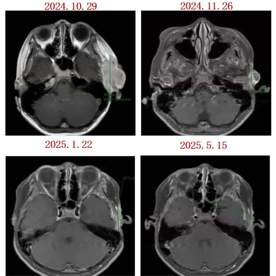 一例8岁NTRK重排梭形细胞肿瘤多次复发后经ICP-723治疗的临床突破
