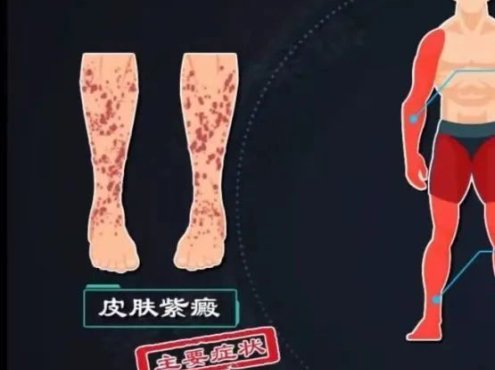【健康科普】过敏性紫癜怎么办?