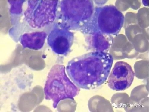 淋巴细胞减少症