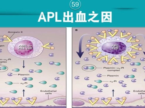 凝血知多少‖急性早幼粒细胞白血病(APL)出血之因
