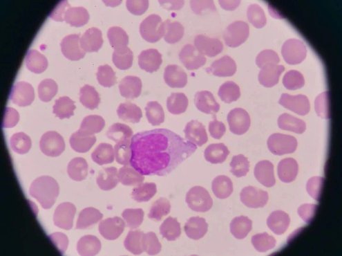 嗜酸性粒细胞升高是怎么回事?